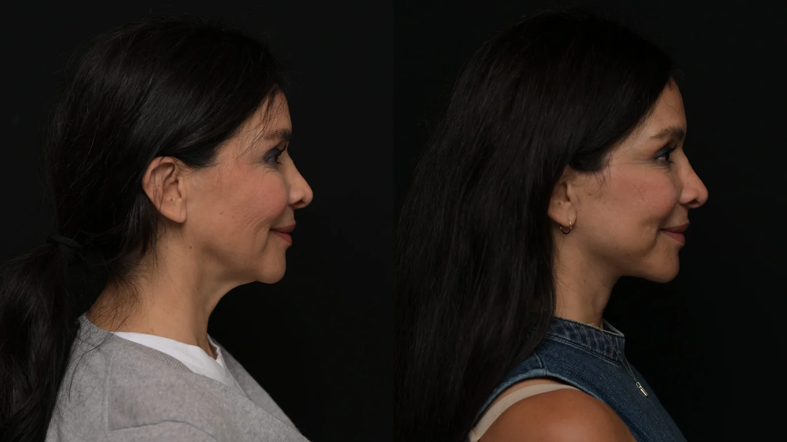 Before-and-after photograph, deep plane facelift and neck lift
