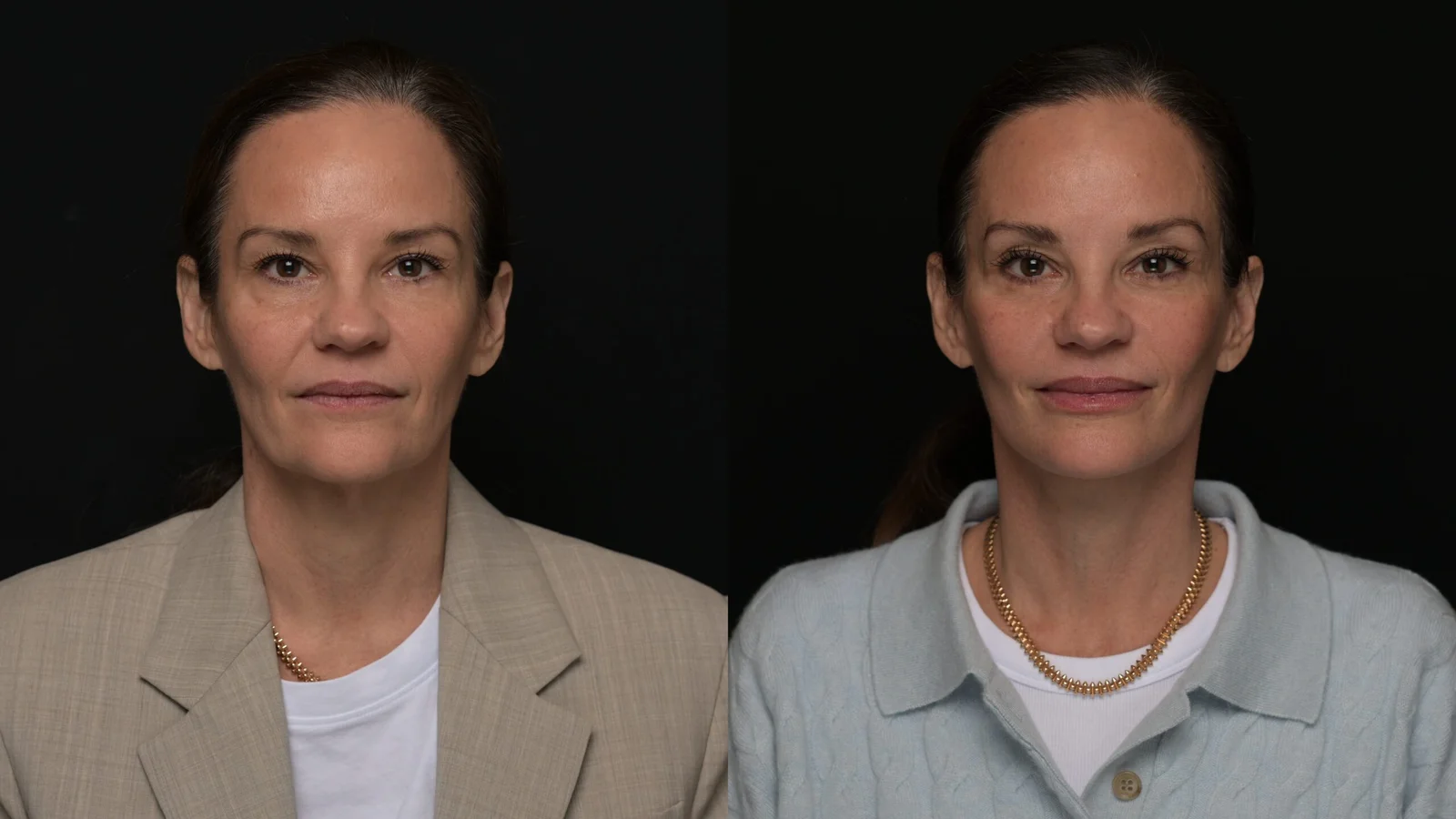 Before-and-after photograph, deep plane facelift and neck lift