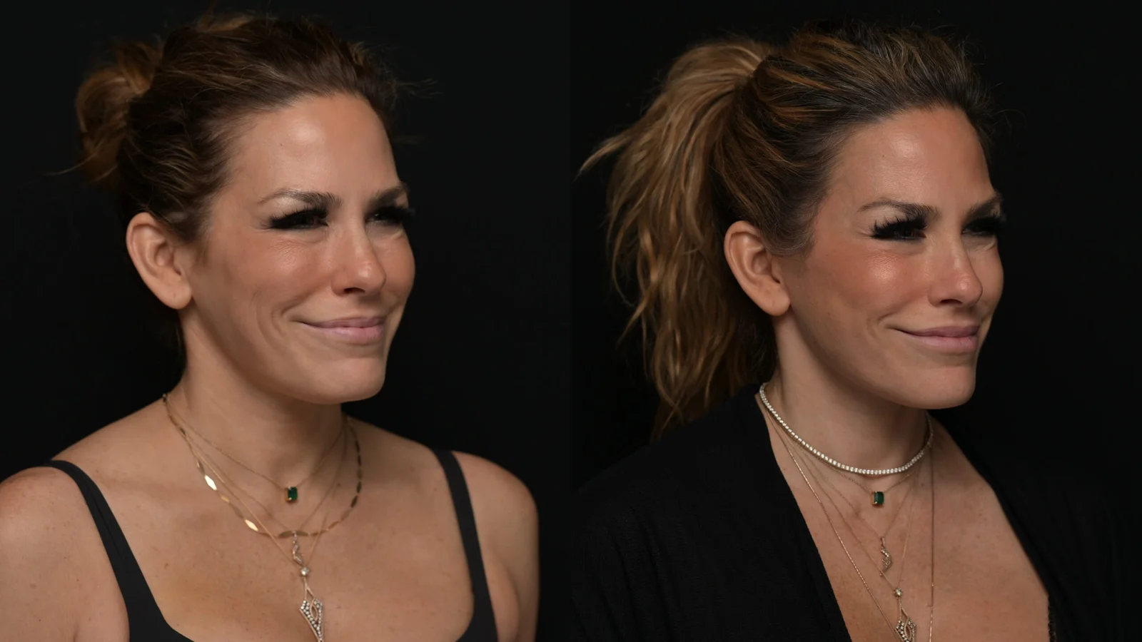 Before-and-after photograph, deep plane facelift and neck lift