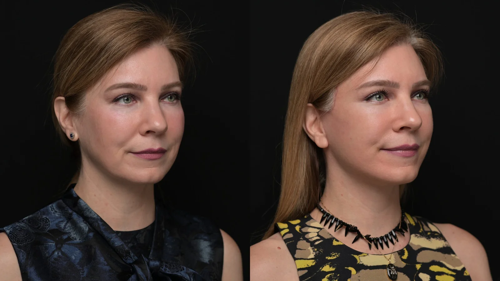 Before-and-after photograph, deep plane facelift and neck lift