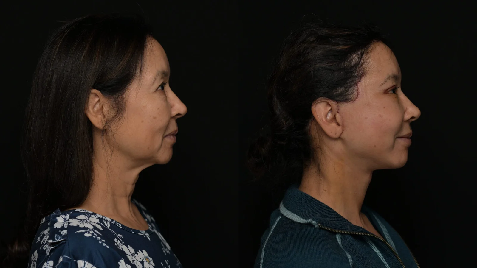 Before-and-after photograph, deep plane facelift and neck lift