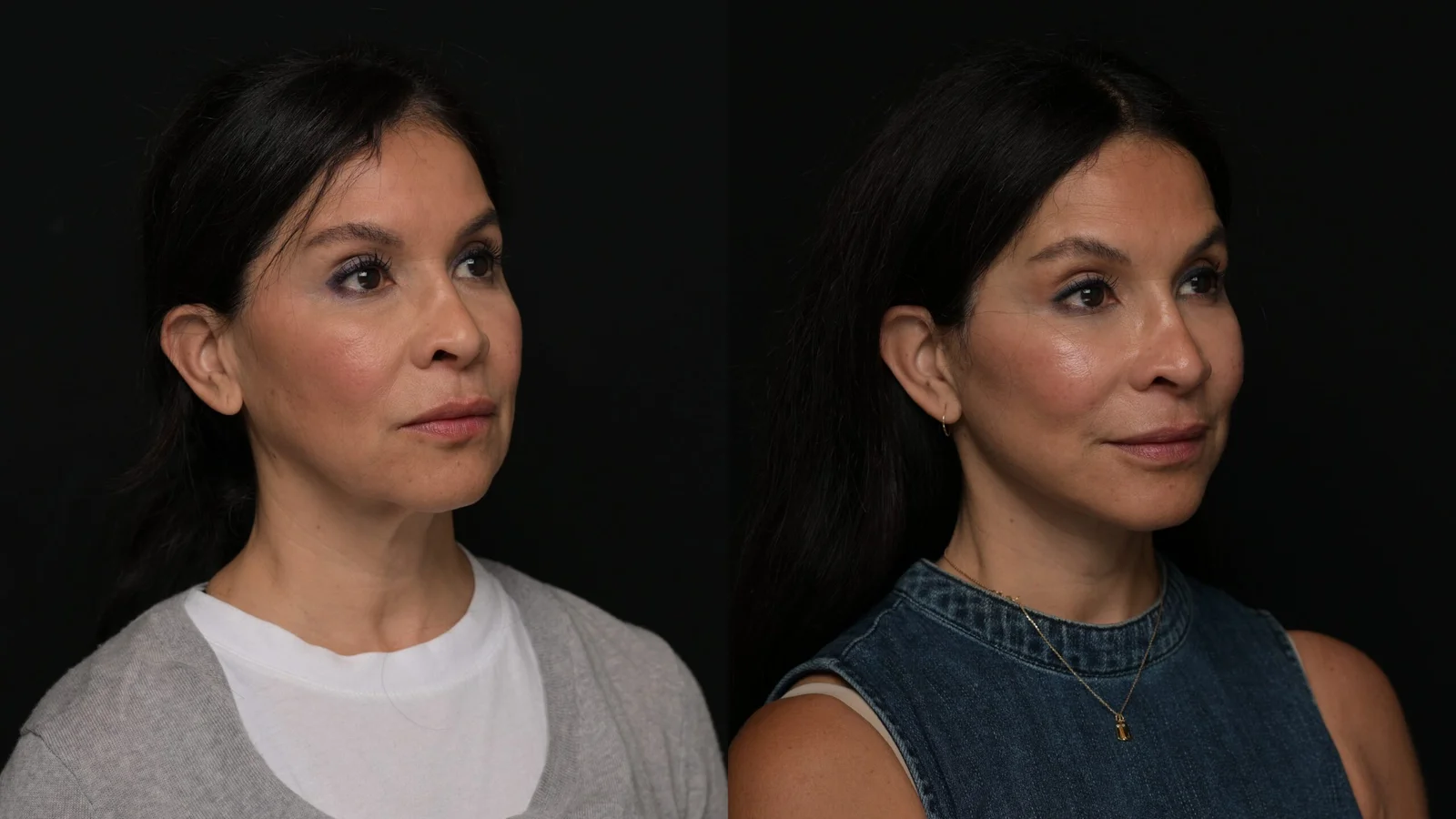 Before-and-after photograph, deep plane facelift and neck lift
