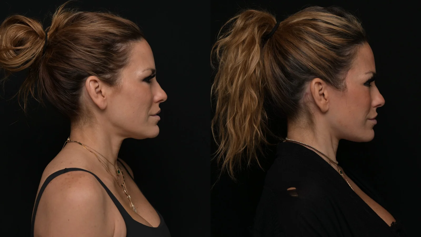 Before-and-after photograph, deep plane facelift and neck lift