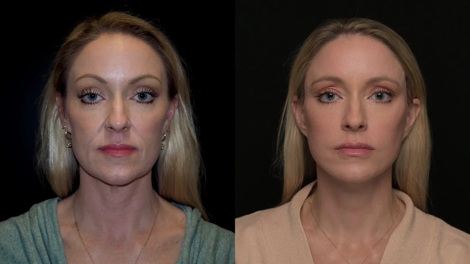 Before-and-after photograph, deep plane facelift and neck lift