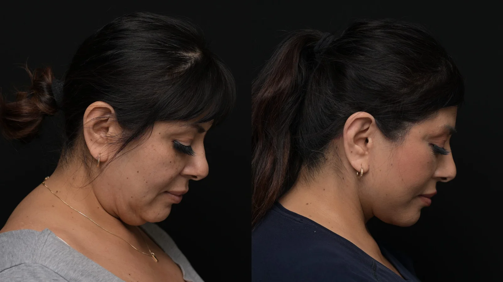 Before-and-after photograph, deep plane facelift and neck lift
