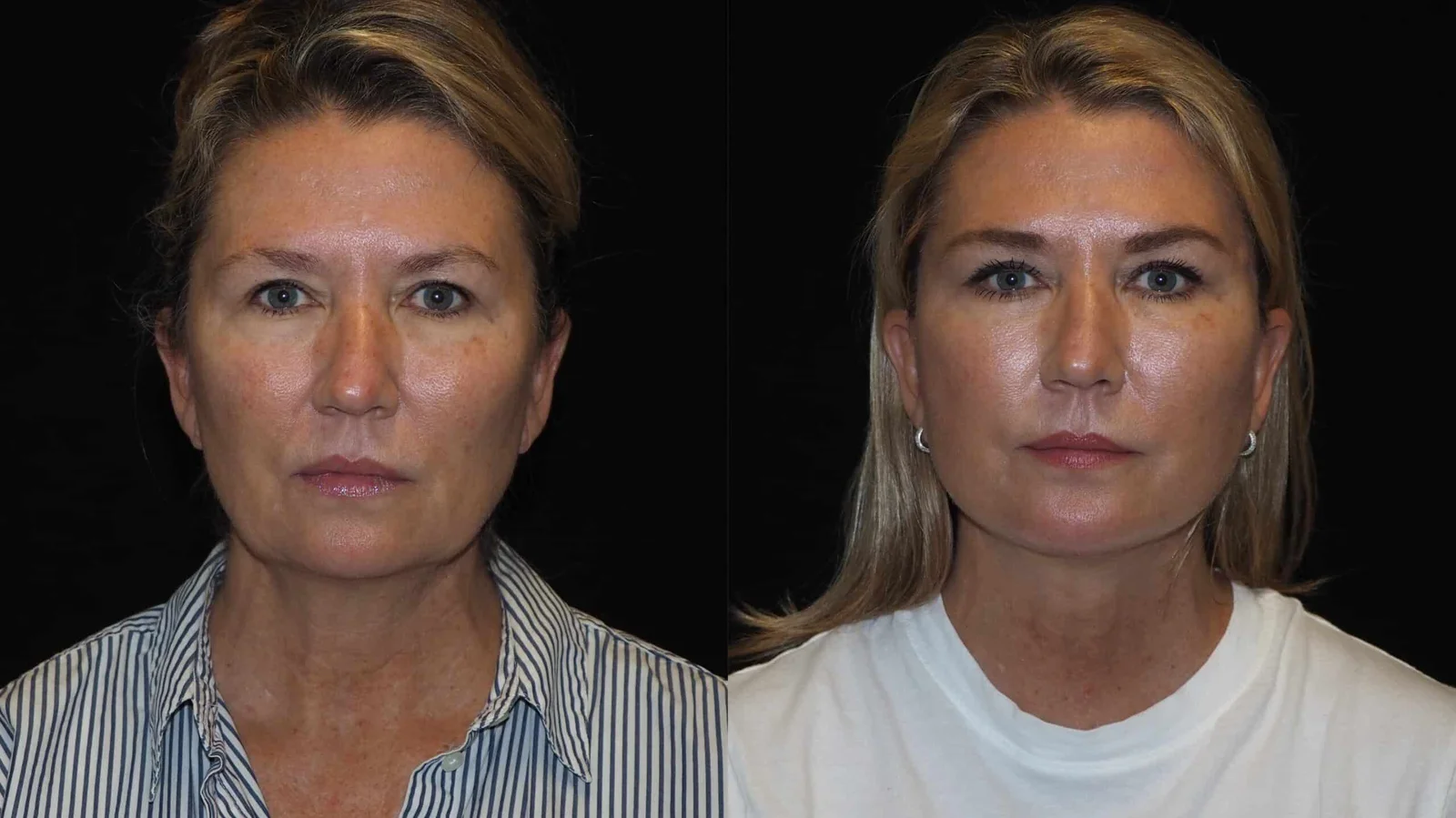 Before-and-after photograph, deep plane facelift and neck lift