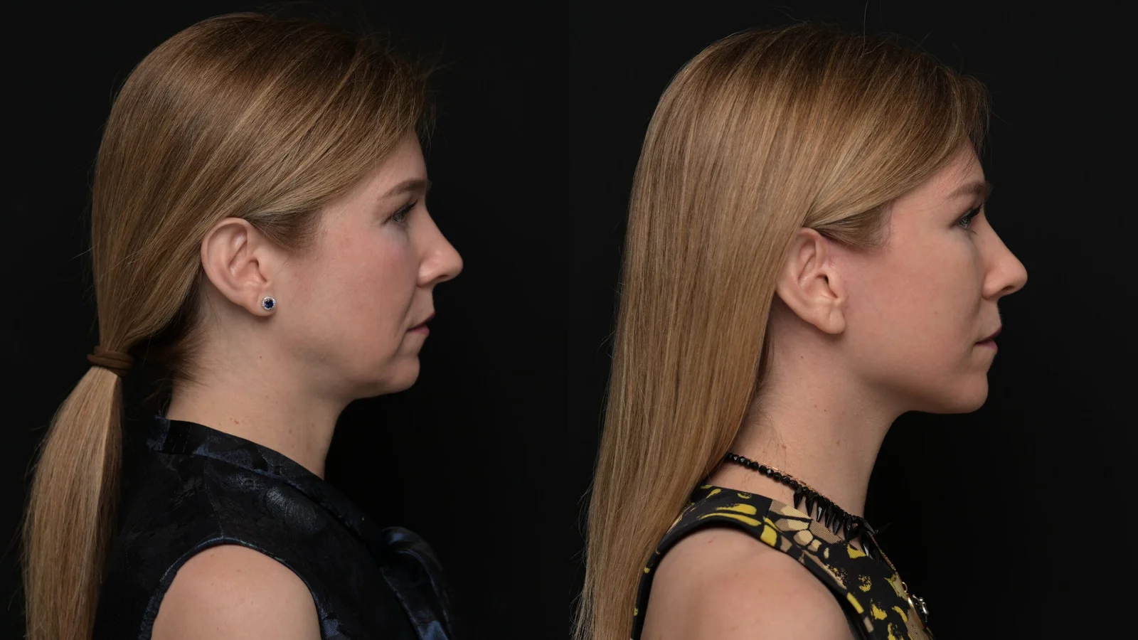 Before-and-after photograph, deep plane facelift and neck lift
