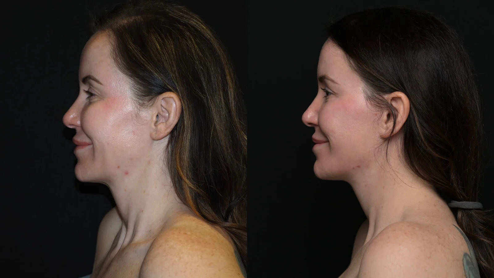 Before-and-after photograph, deep plane facelift and neck lift