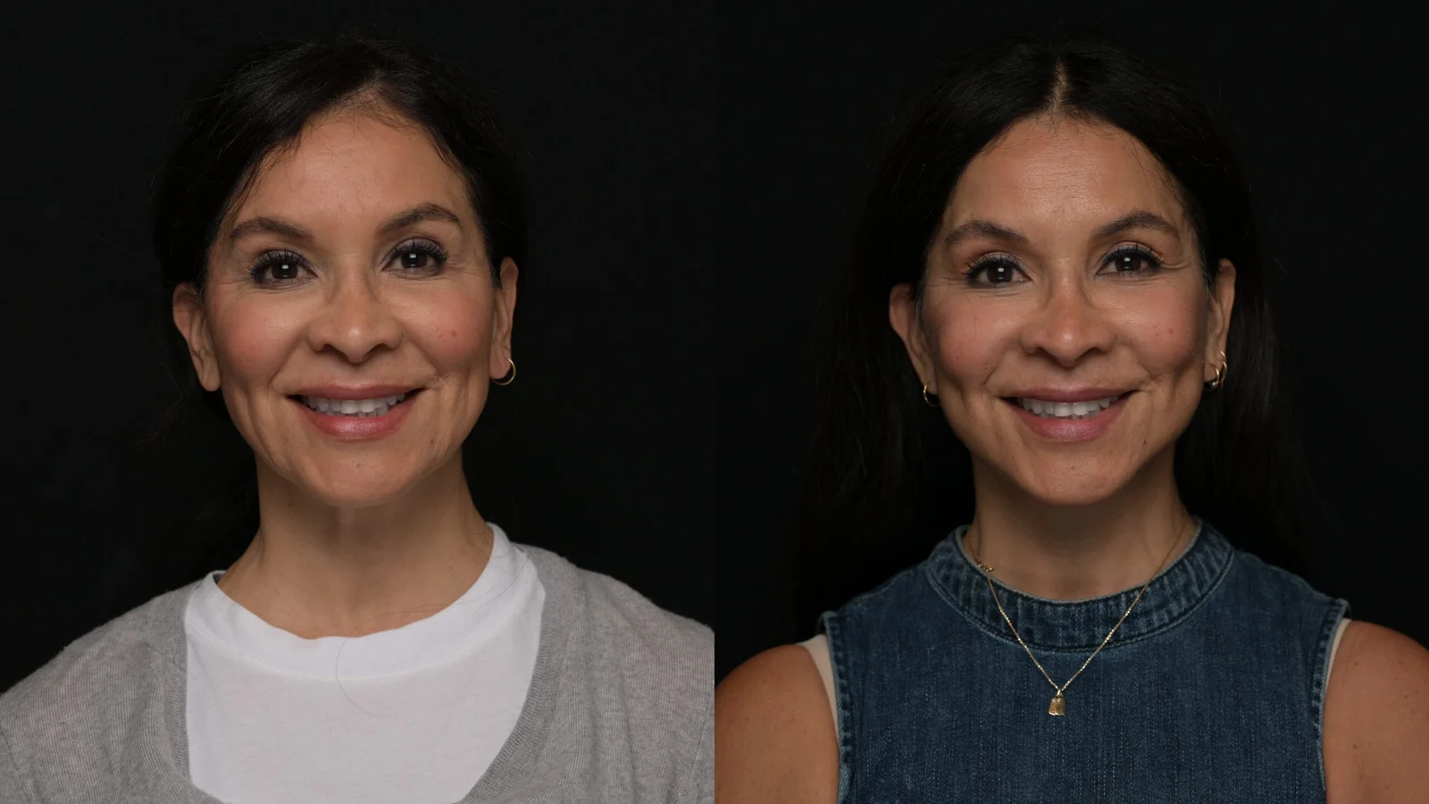 Before-and-after photograph, deep plane facelift and neck lift