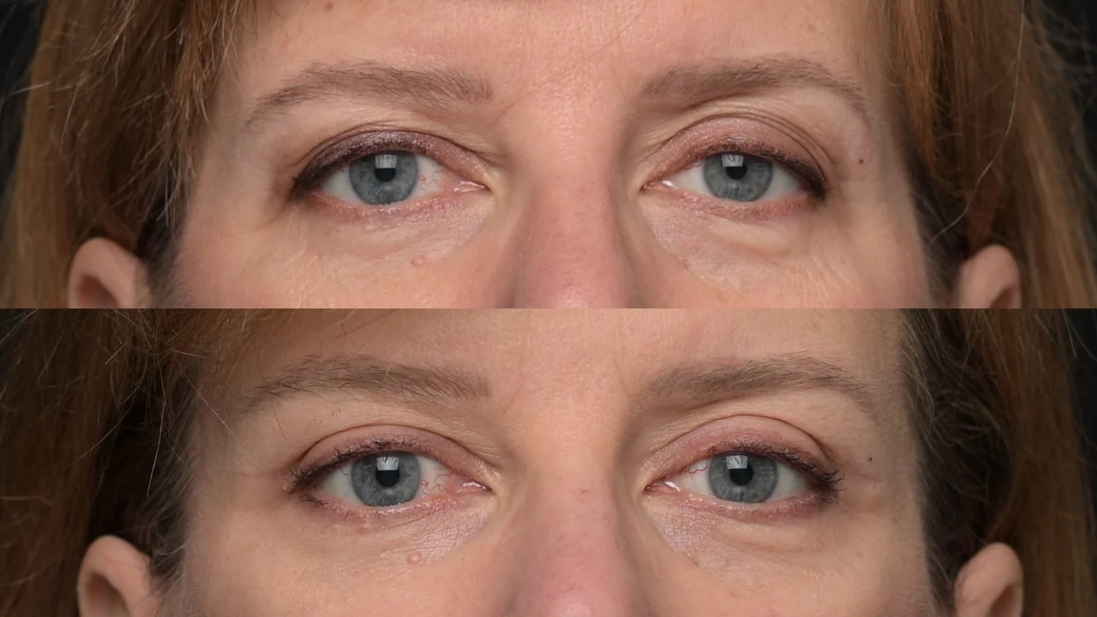 Before-and-after photograph, blepharoplasty