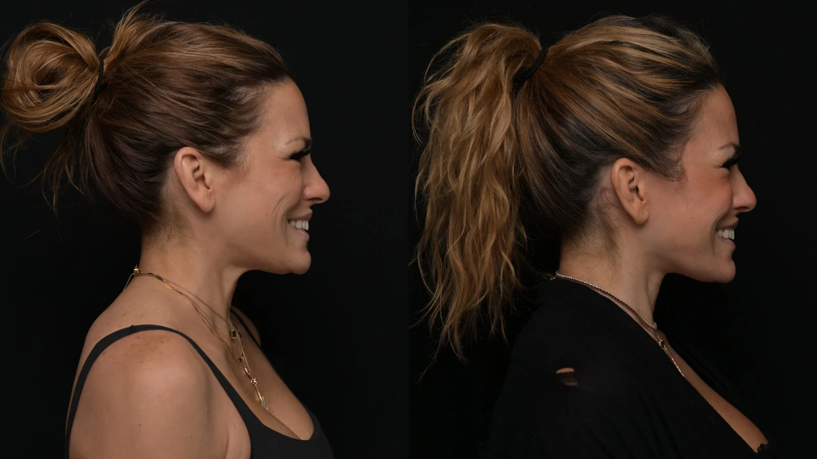 Before-and-after photograph, deep plane facelift and neck lift