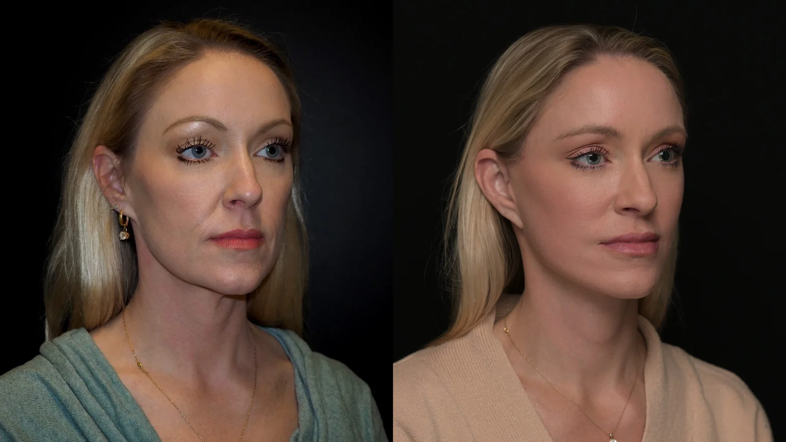 Before-and-after photograph, deep plane facelift and neck lift