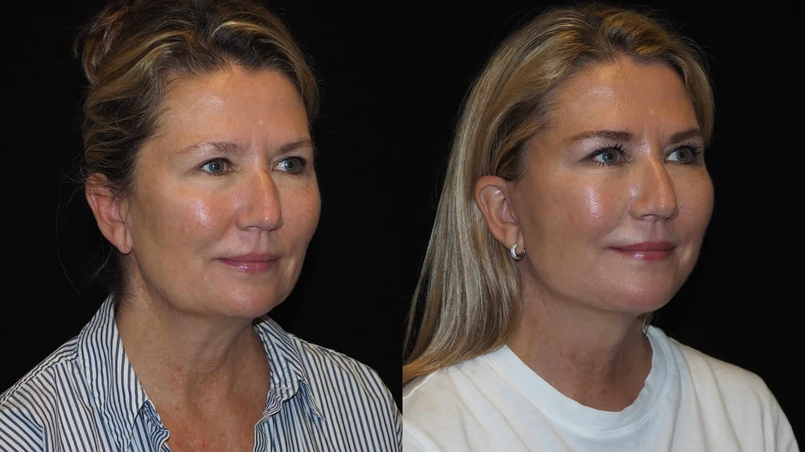Before-and-after photograph, deep plane facelift and neck lift