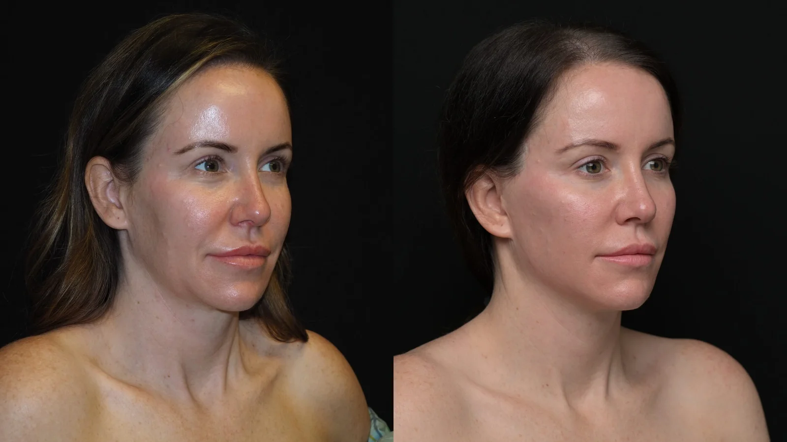 Before-and-after photograph, deep plane facelift and neck lift