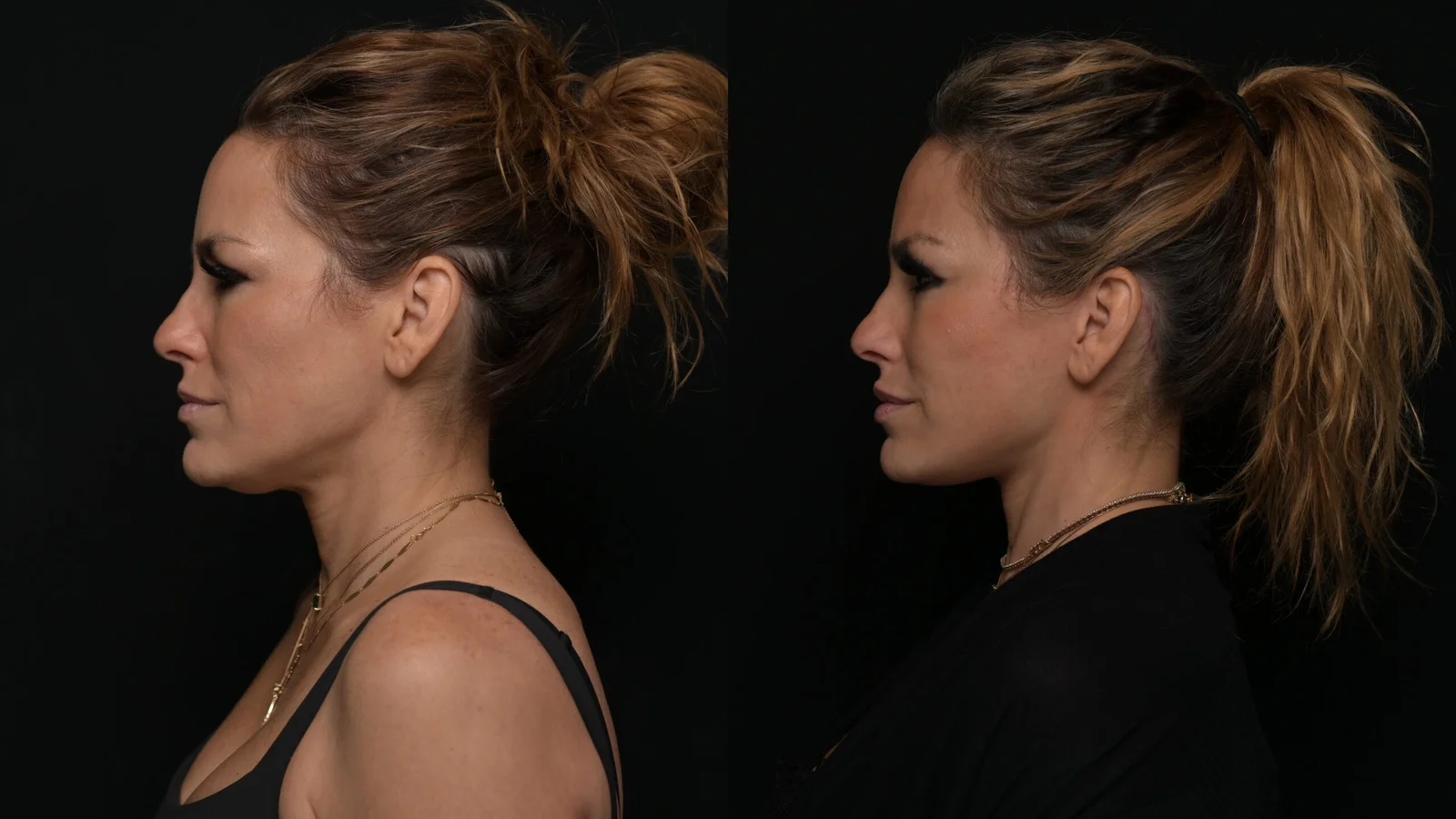 Before-and-after photograph, deep plane facelift and neck lift