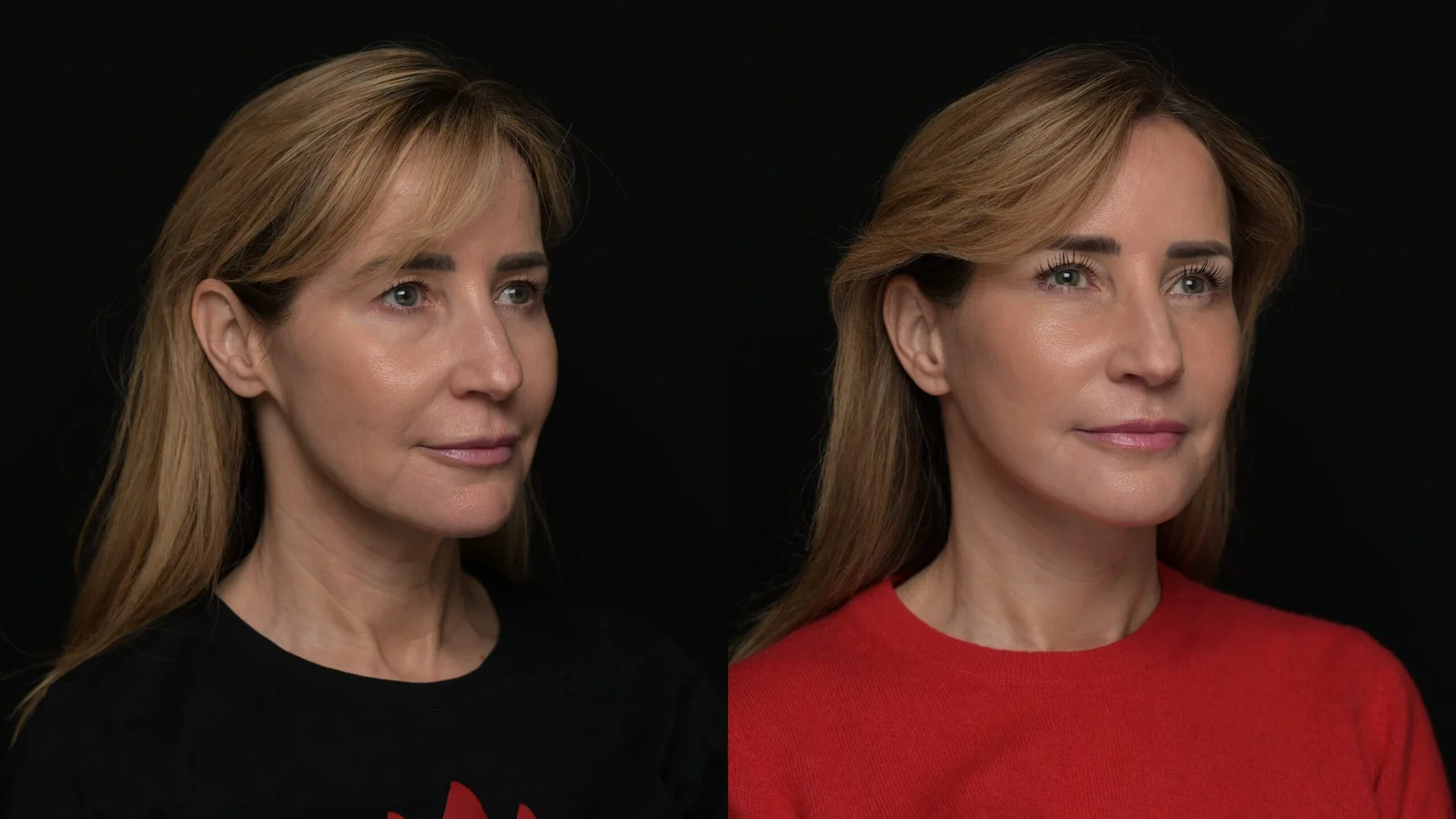 Before-and-after photograph, deep plane facelift and neck lift