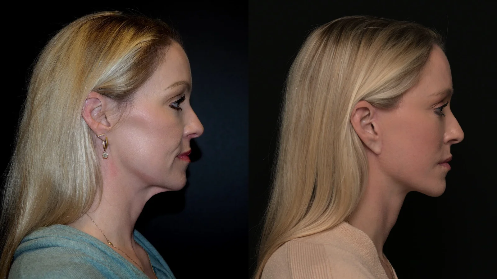 Before-and-after photograph, deep plane facelift and neck lift