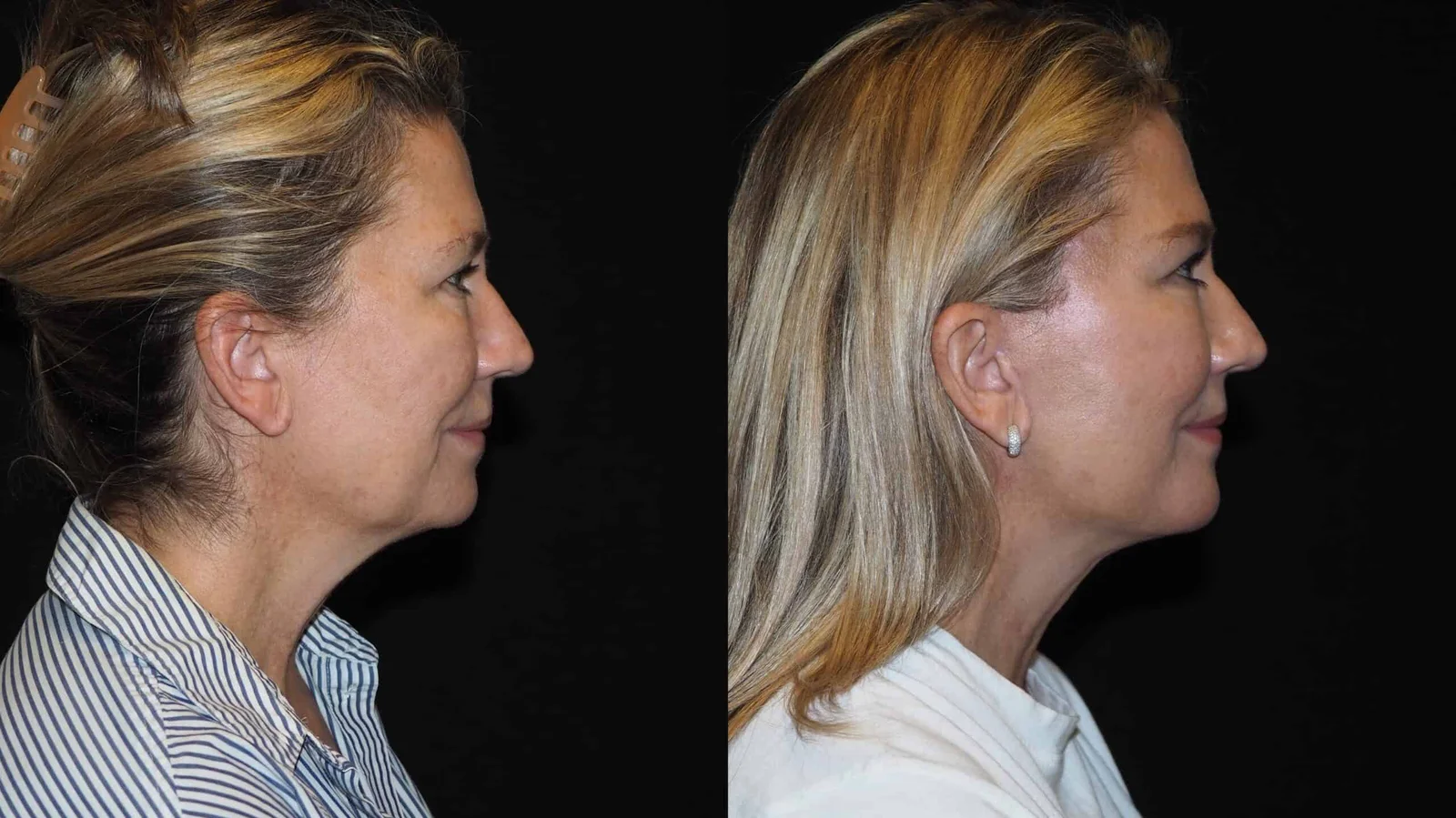 Before-and-after photograph, deep plane facelift and neck lift