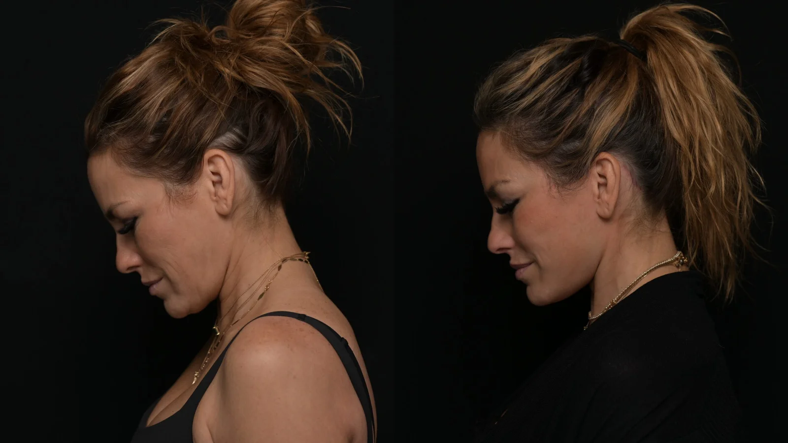 Before-and-after photograph, deep plane facelift and neck lift