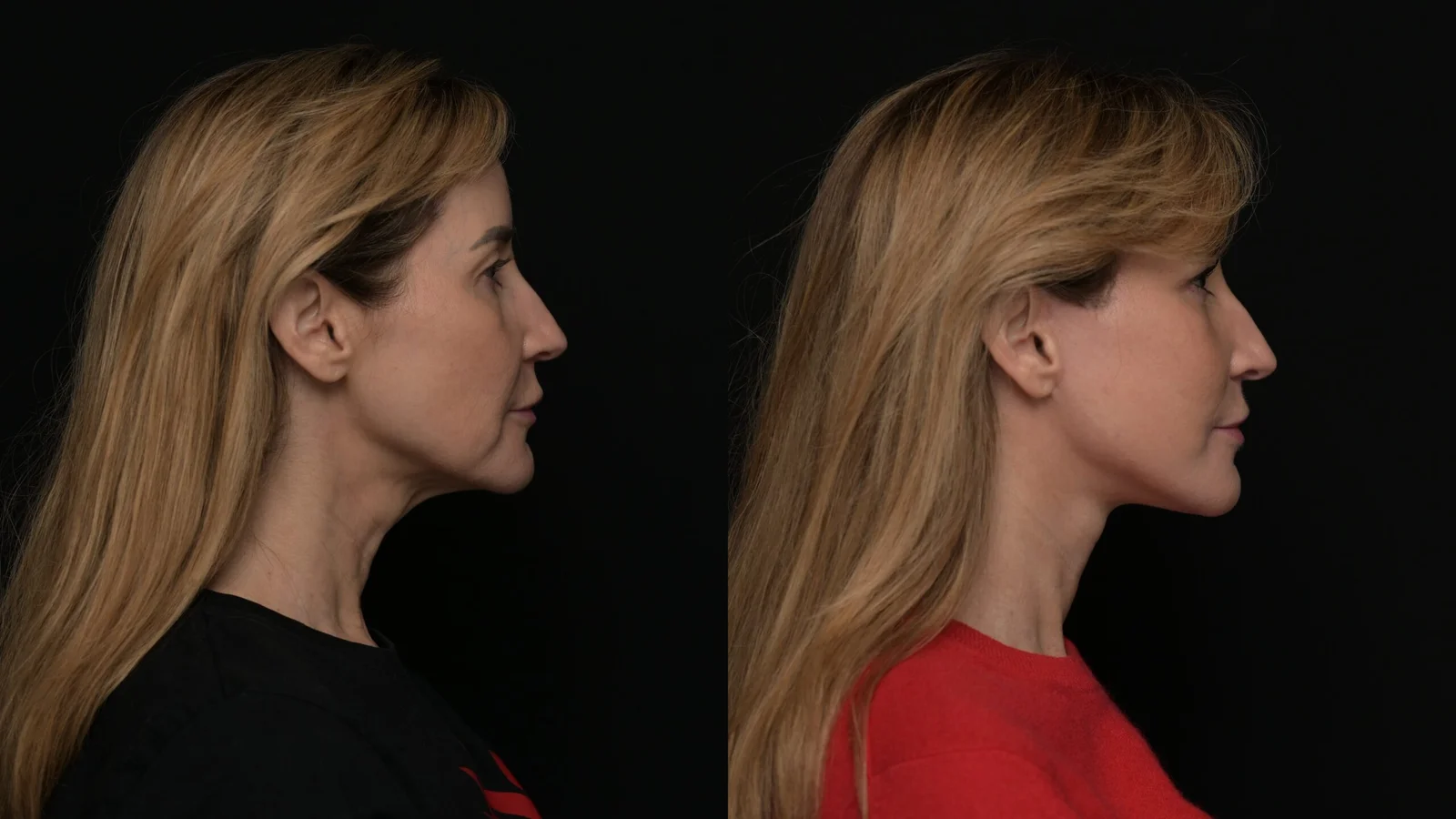 Before-and-after photograph, deep plane facelift and neck lift