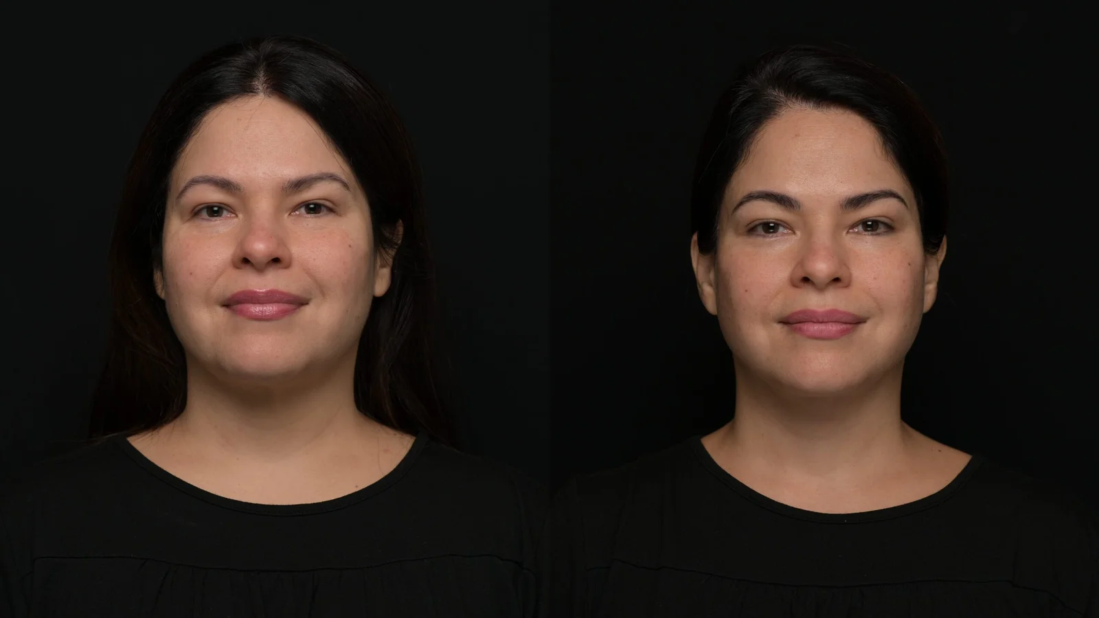 Before-and-after photograph, deep plane facelift and neck lift