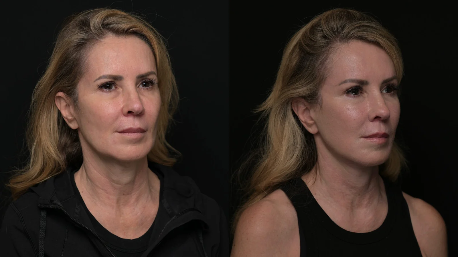 Before-and-after photograph, deep plane facelift and neck lift