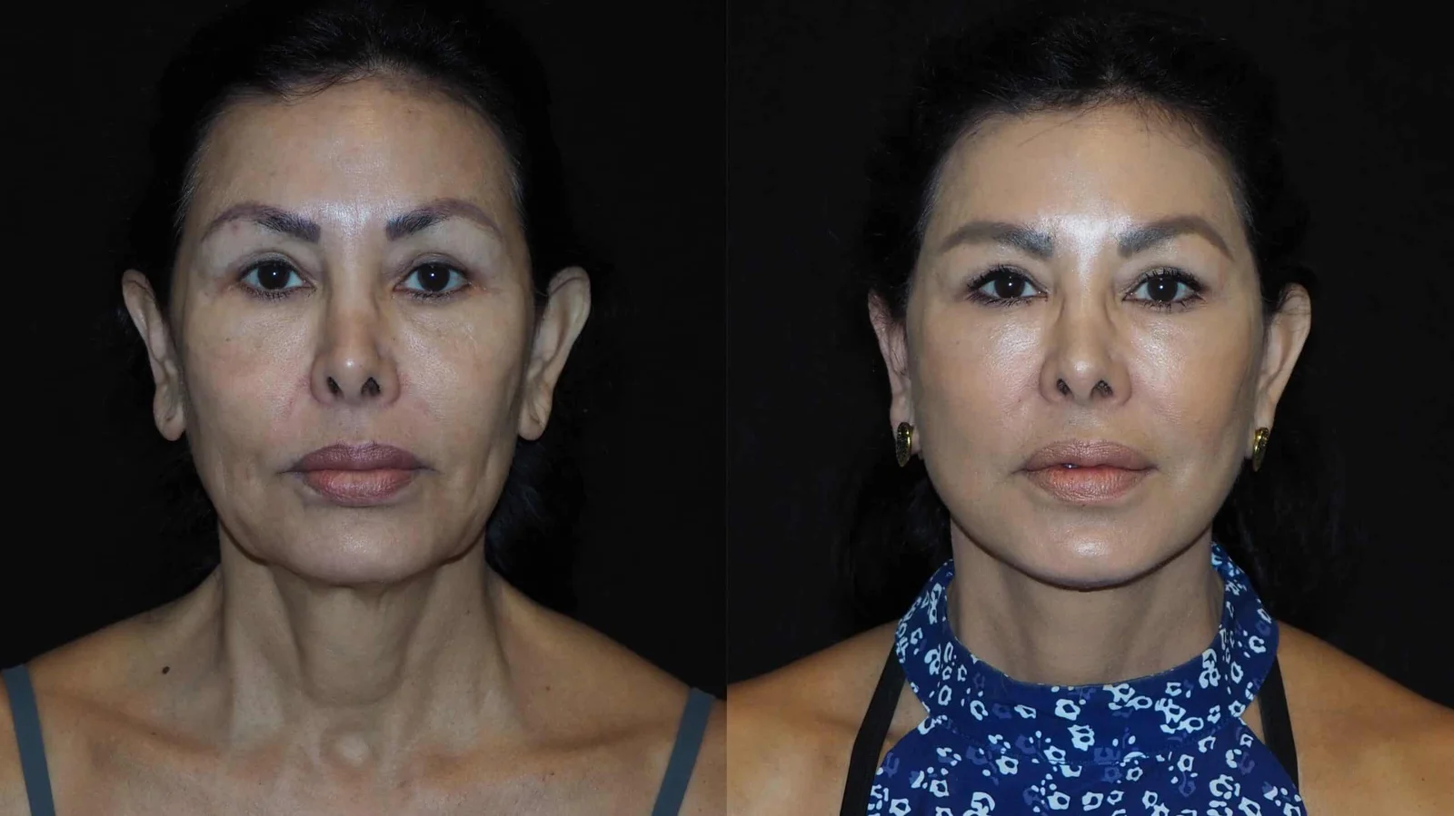 Before-and-after photograph, deep plane facelift and neck lift