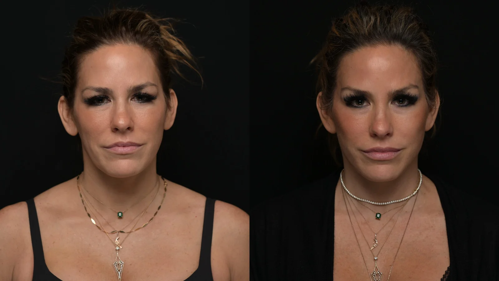 Before-and-after photograph, deep plane facelift and neck lift