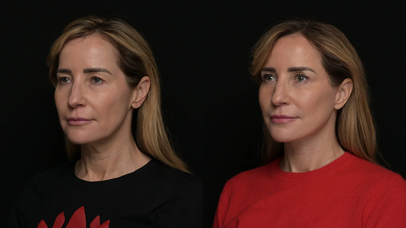 Before-and-after photograph, deep plane facelift and neck lift