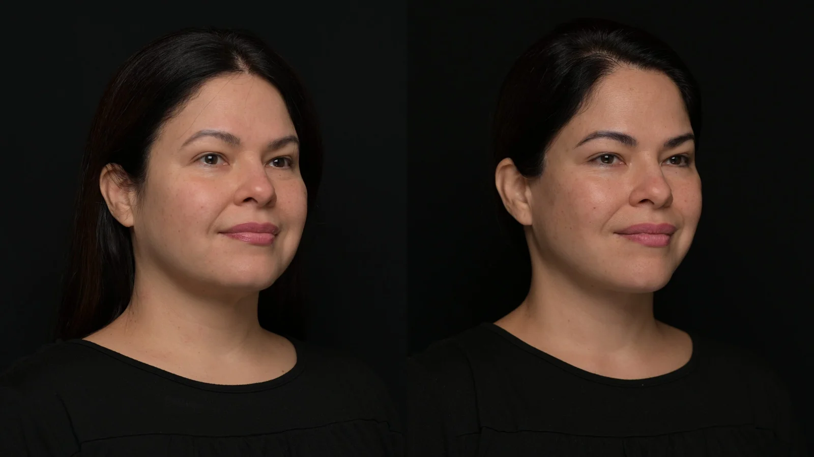 Before-and-after photograph, deep plane facelift and neck lift