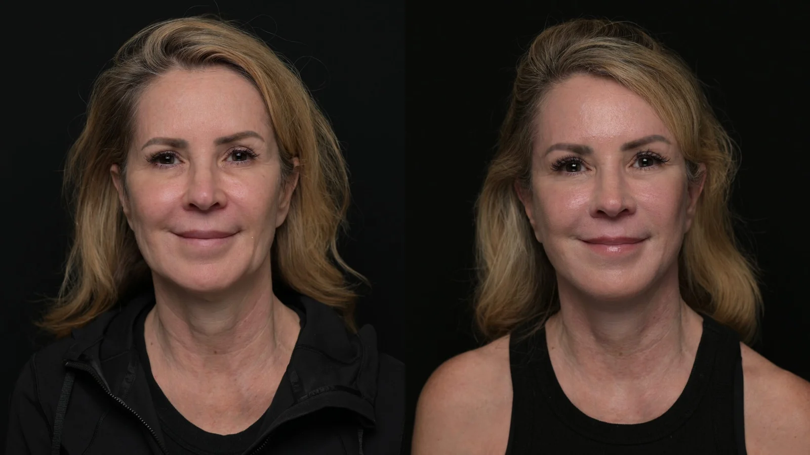 Before-and-after photograph, deep plane facelift and neck lift