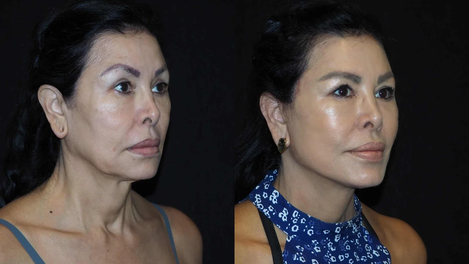 Before-and-after photograph, deep plane facelift and neck lift