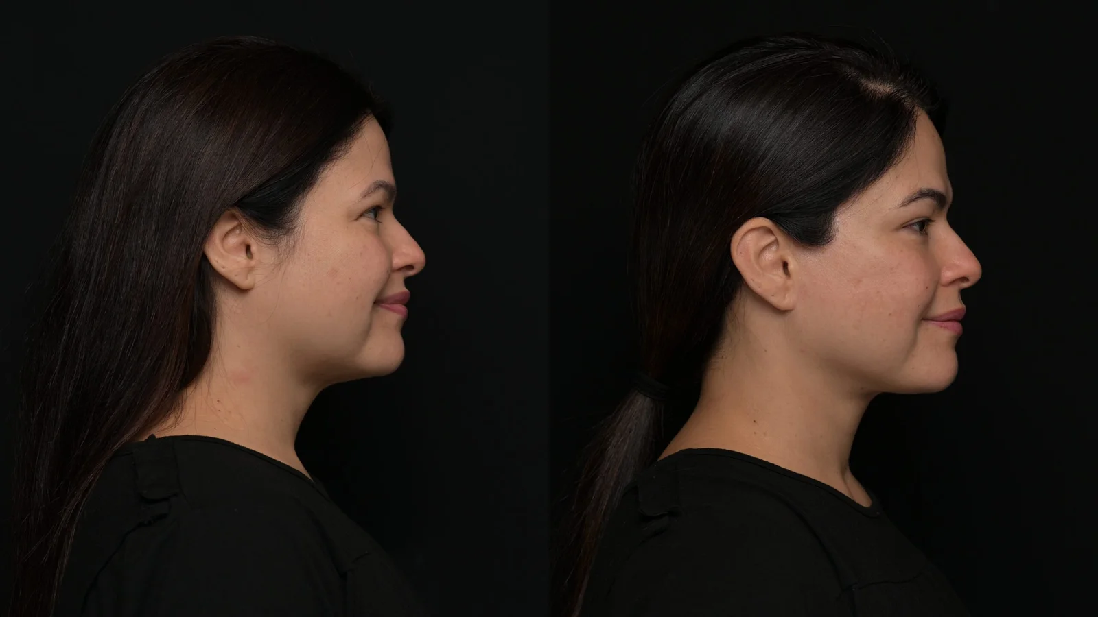 Before-and-after photograph, deep plane facelift and neck lift