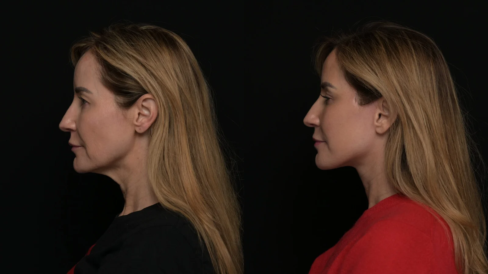 Before-and-after photograph, deep plane facelift and neck lift