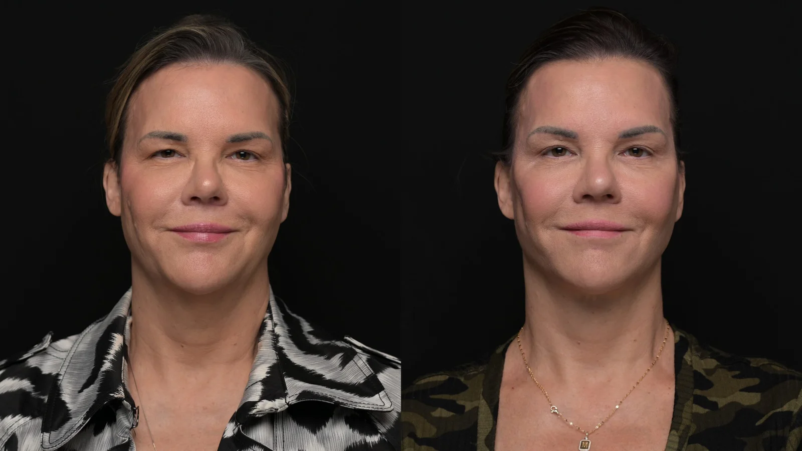 Before-and-after photograph, deep plane facelift and neck lift