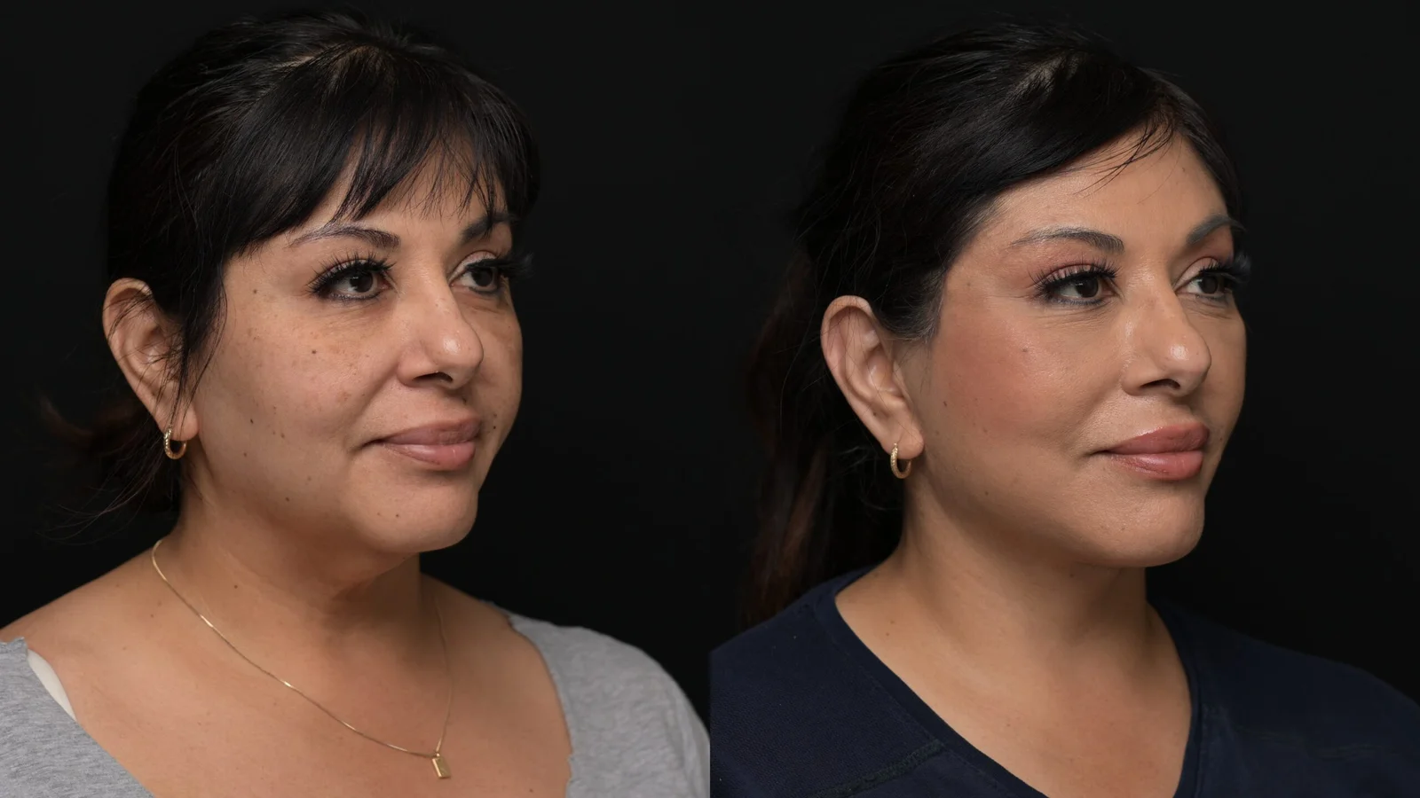 Before-and-after photograph, deep plane facelift and neck lift