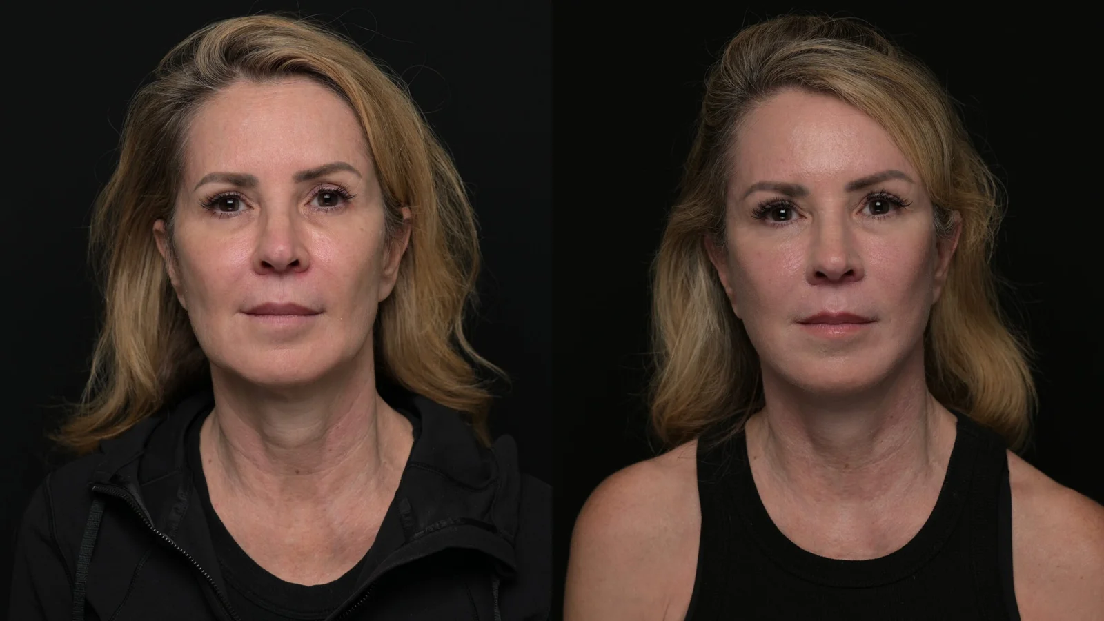 Before-and-after photograph, deep plane facelift and neck lift