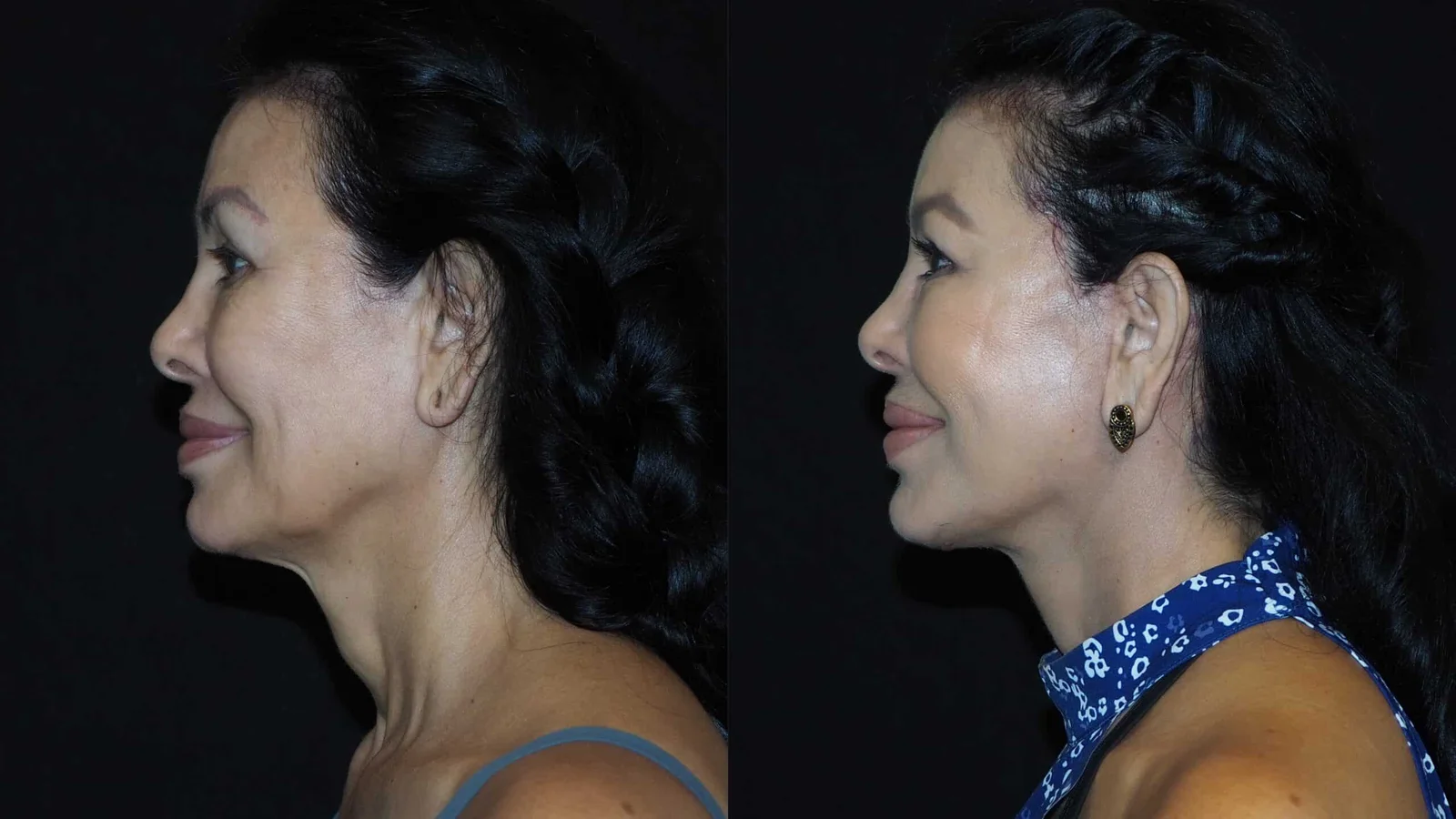 Before-and-after photograph, deep plane facelift and neck lift