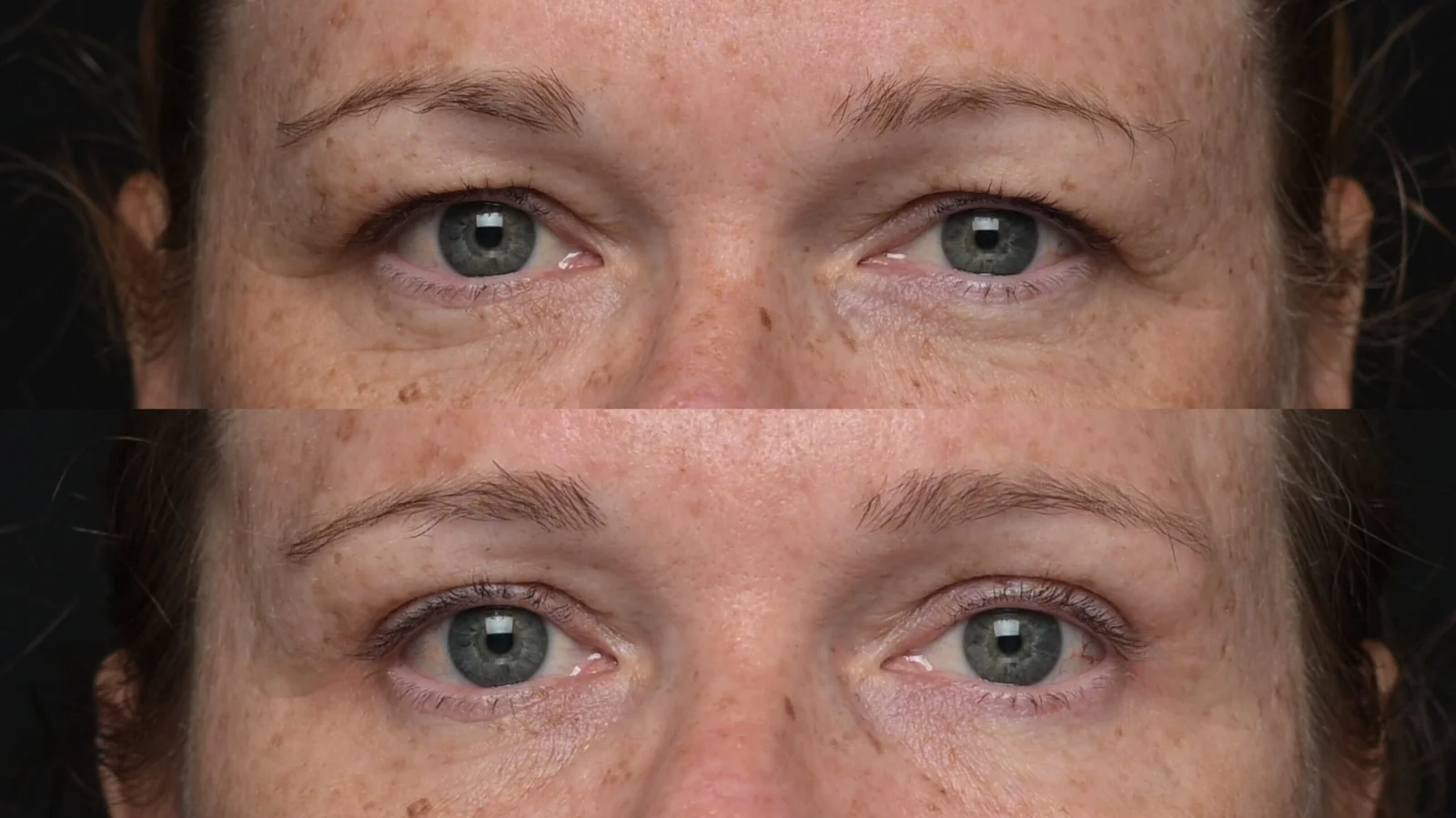 Before-and-after photograph, blepharoplasty