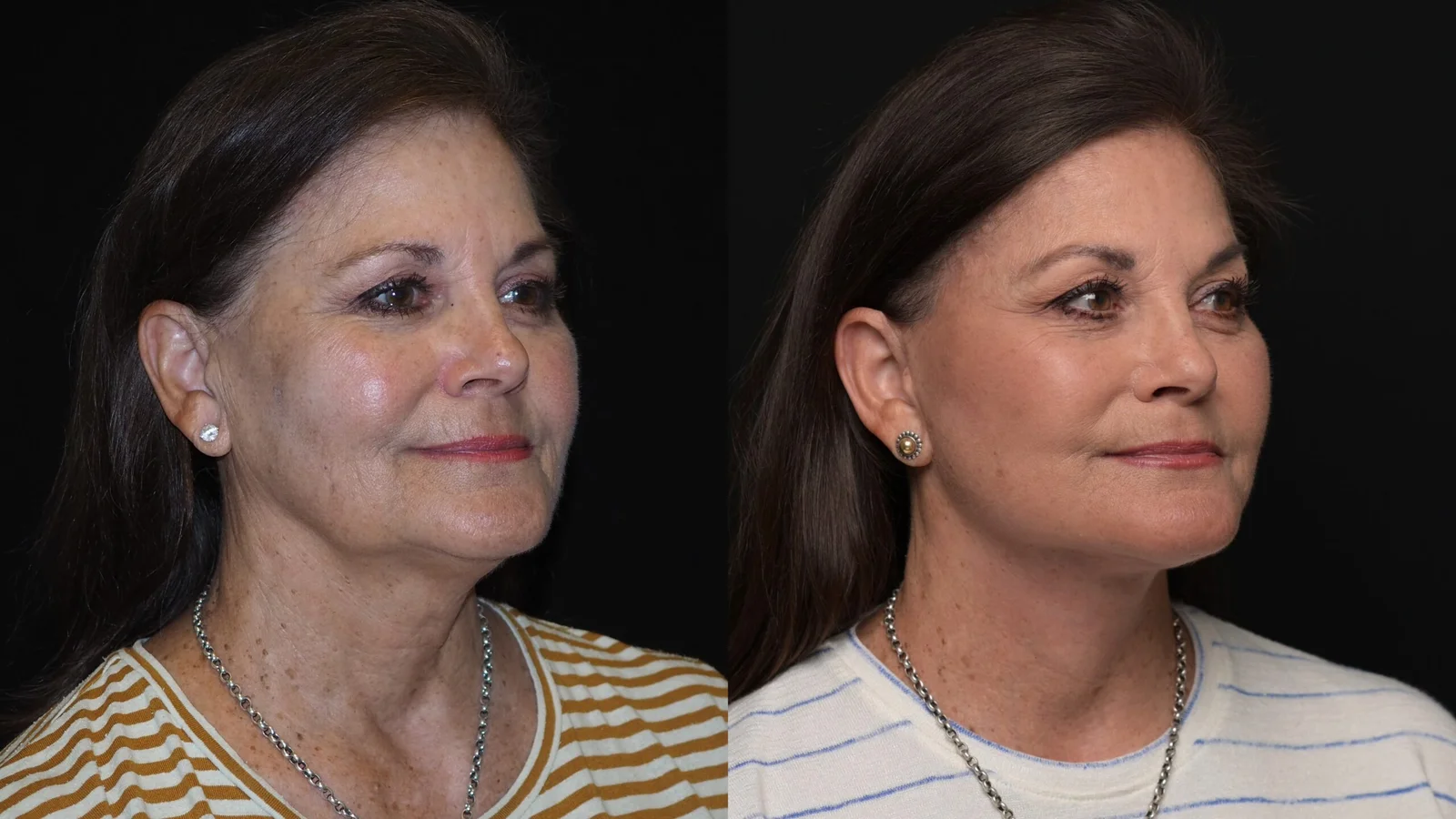 Before-and-after photograph, deep plane facelift and neck lift