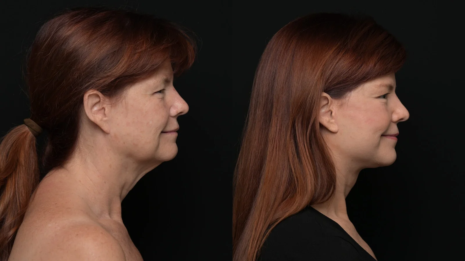 Before-and-after photograph, deep plane facelift and neck lift