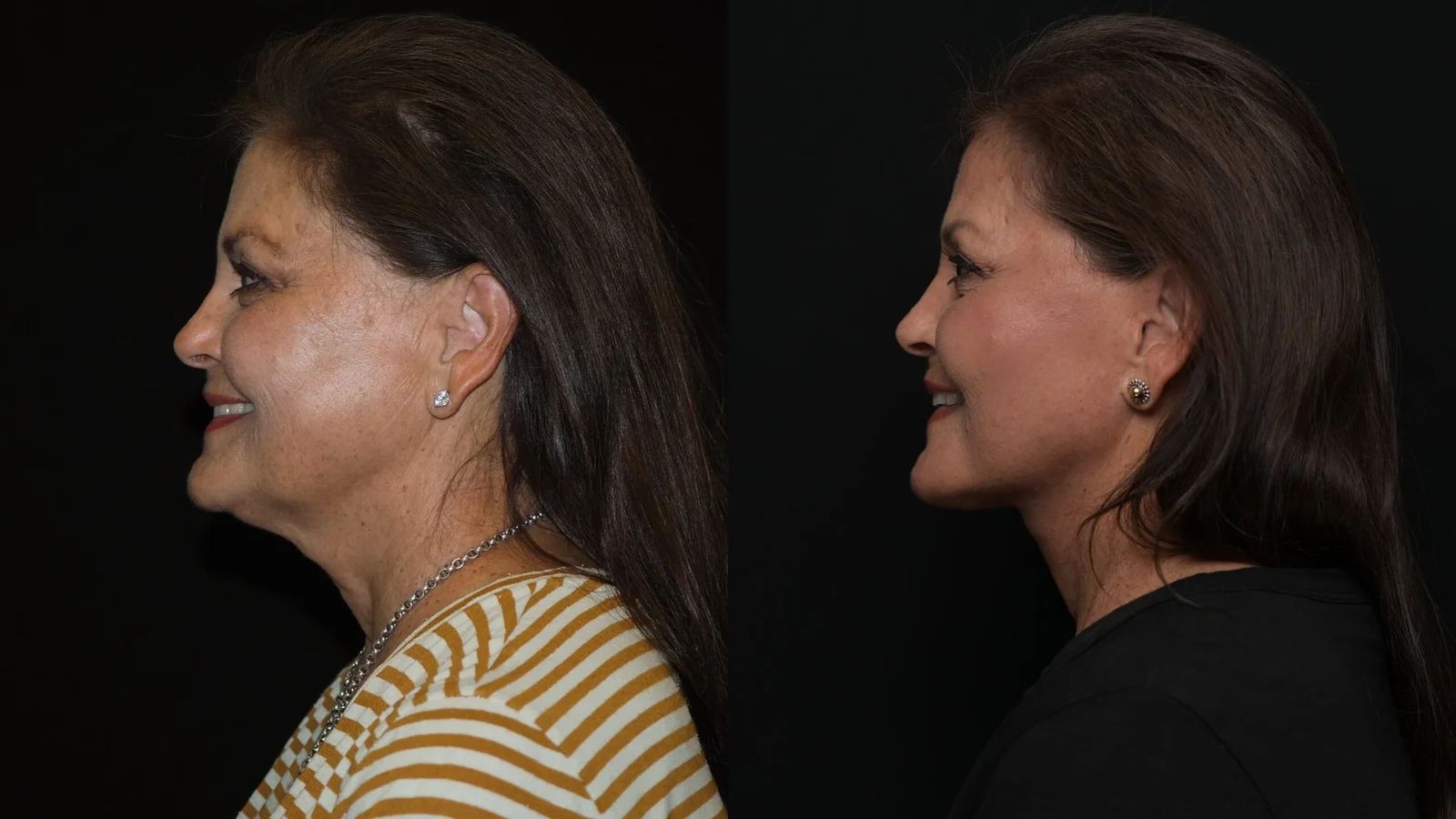 Before-and-after photograph, deep plane facelift and neck lift