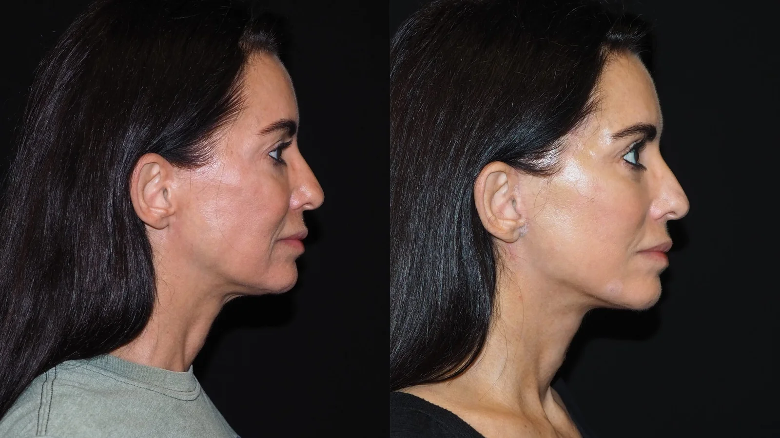 Before-and-after photograph, deep plane facelift and neck lift