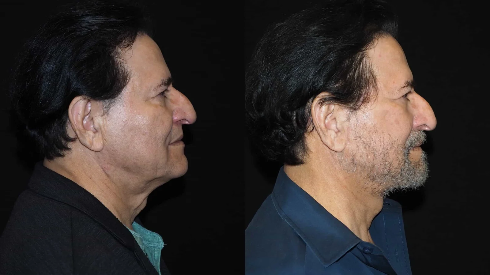 Before-and-after photograph, deep plane facelift and neck lift
