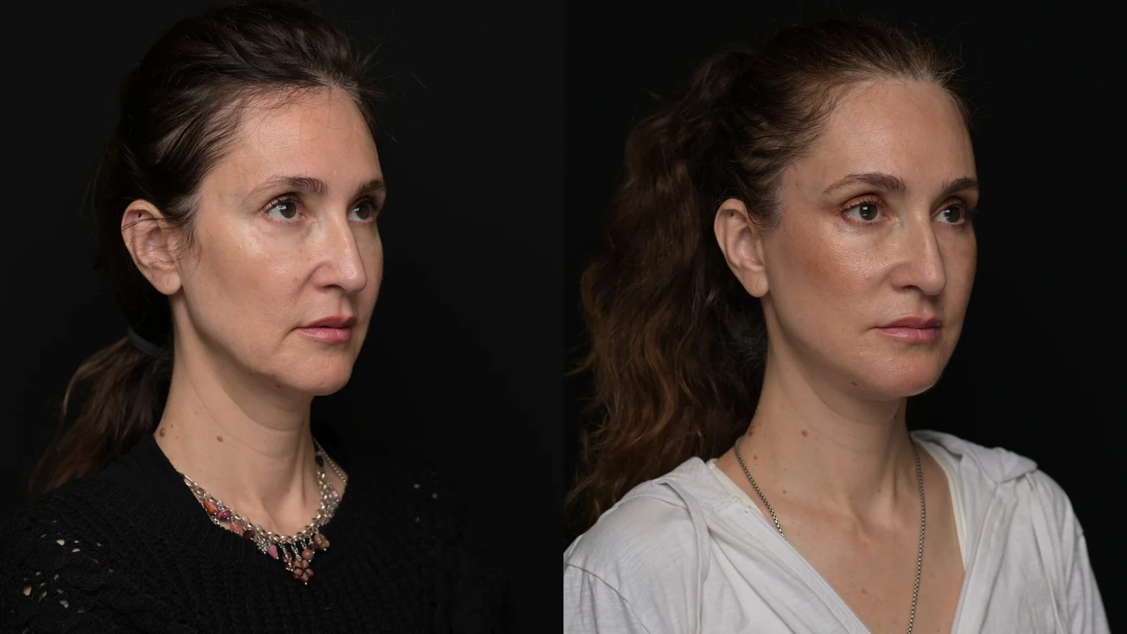 Before-and-after photograph, deep plane facelift and neck lift