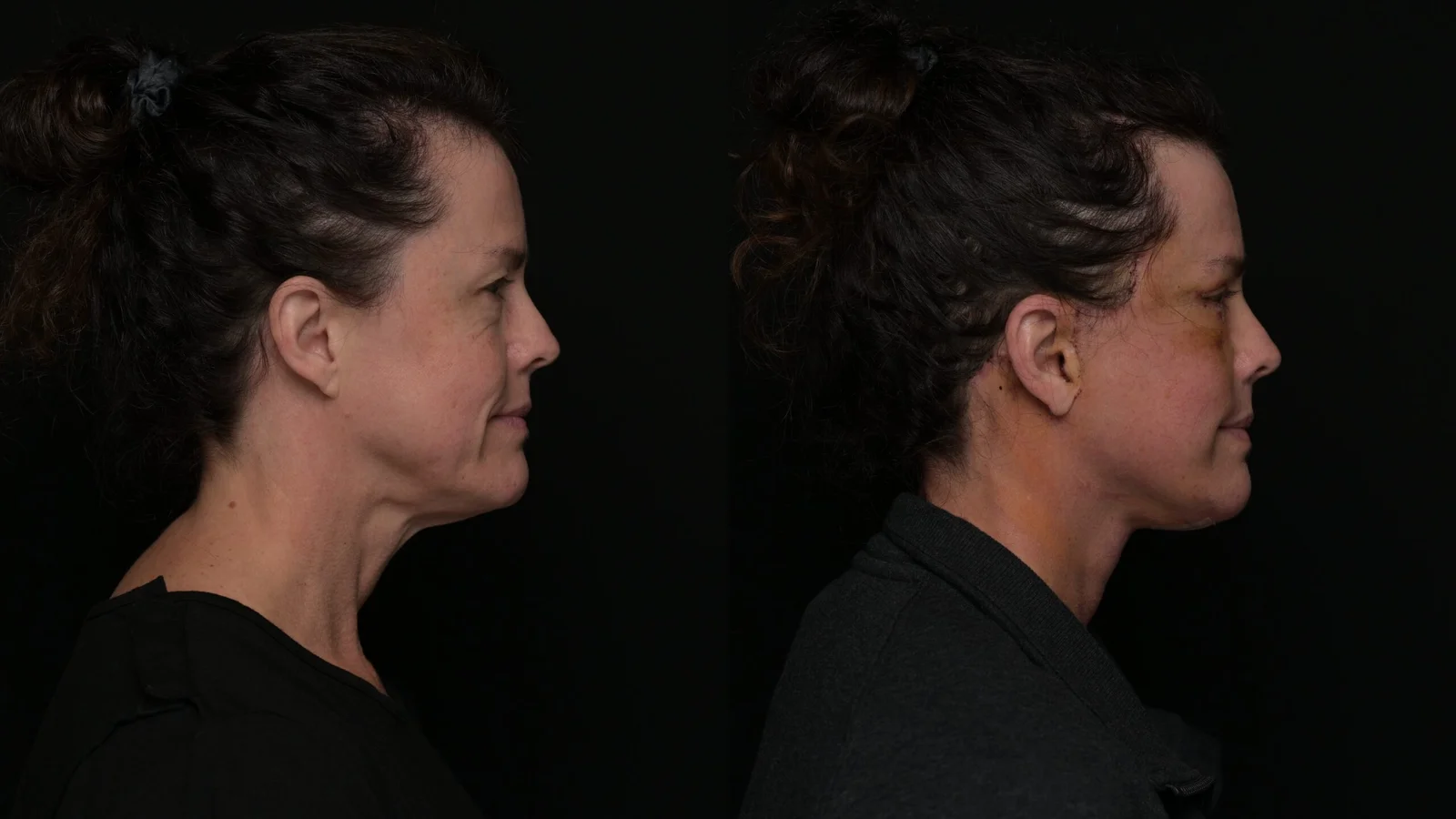 Before-and-after photograph, deep plane facelift and neck lift