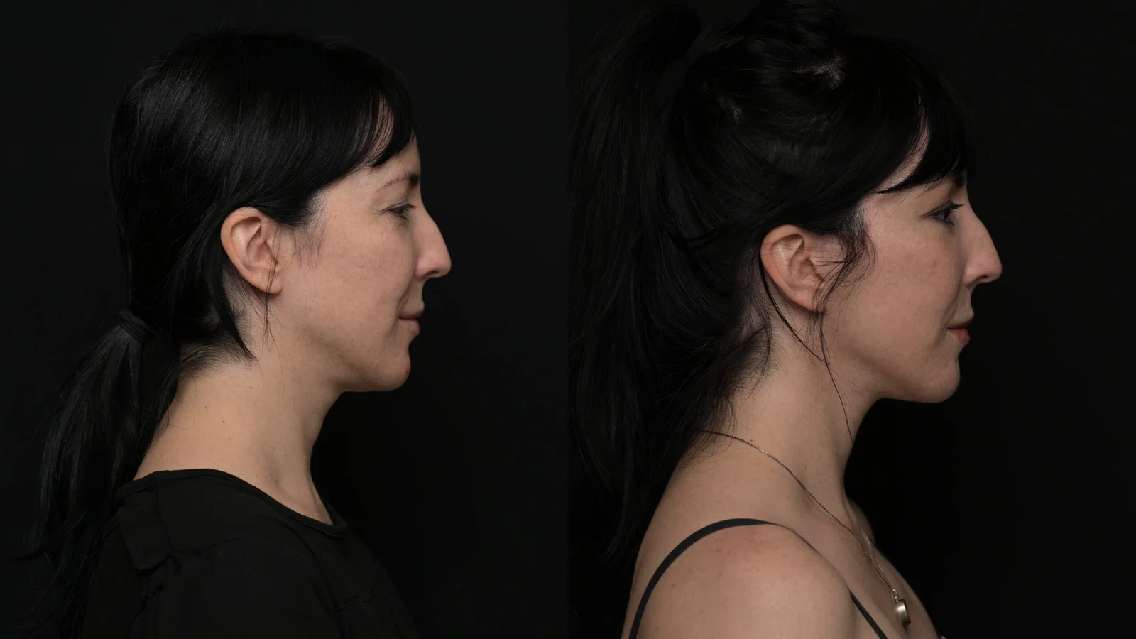Before-and-after photograph, deep plane facelift and neck lift