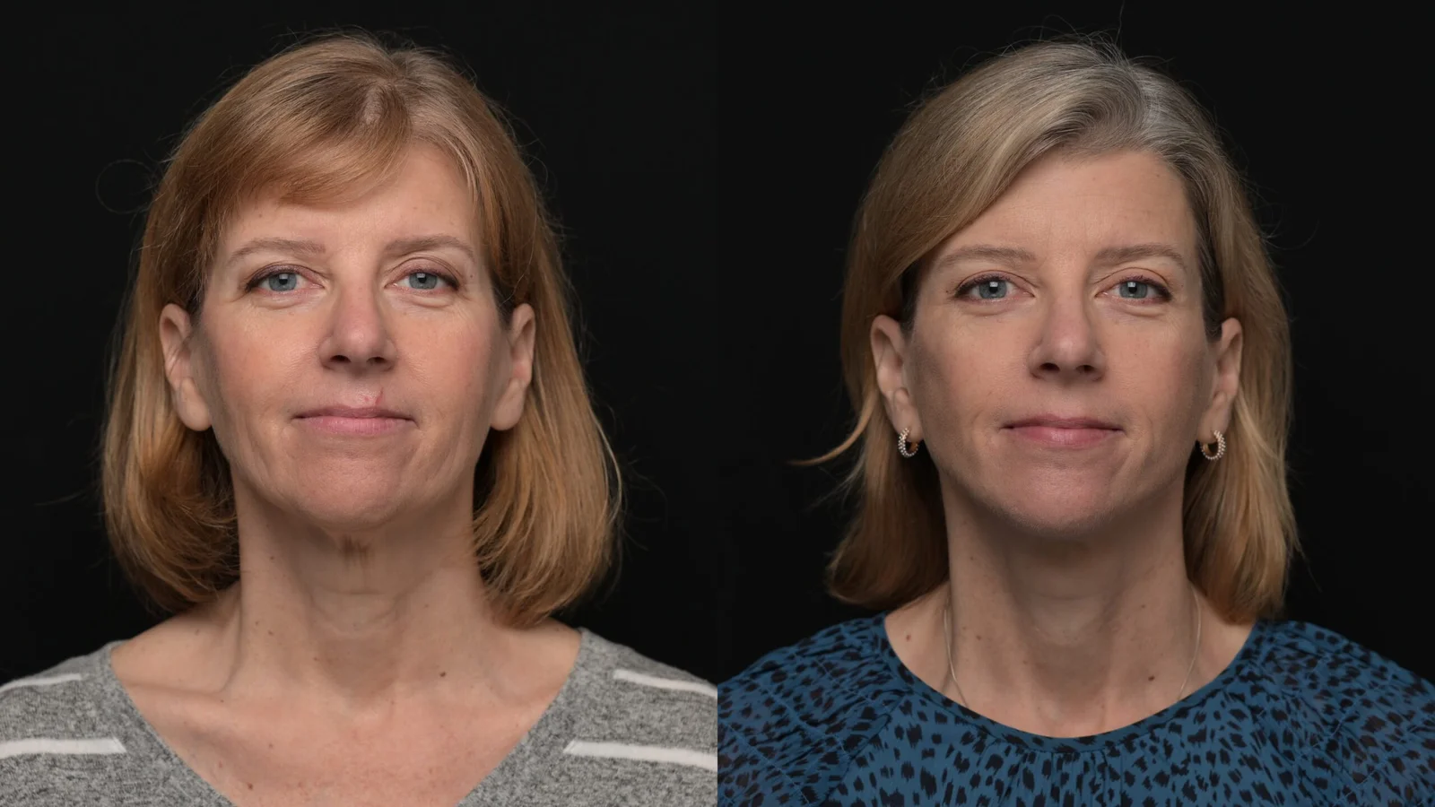 Before-and-after photograph, deep plane facelift and neck lift