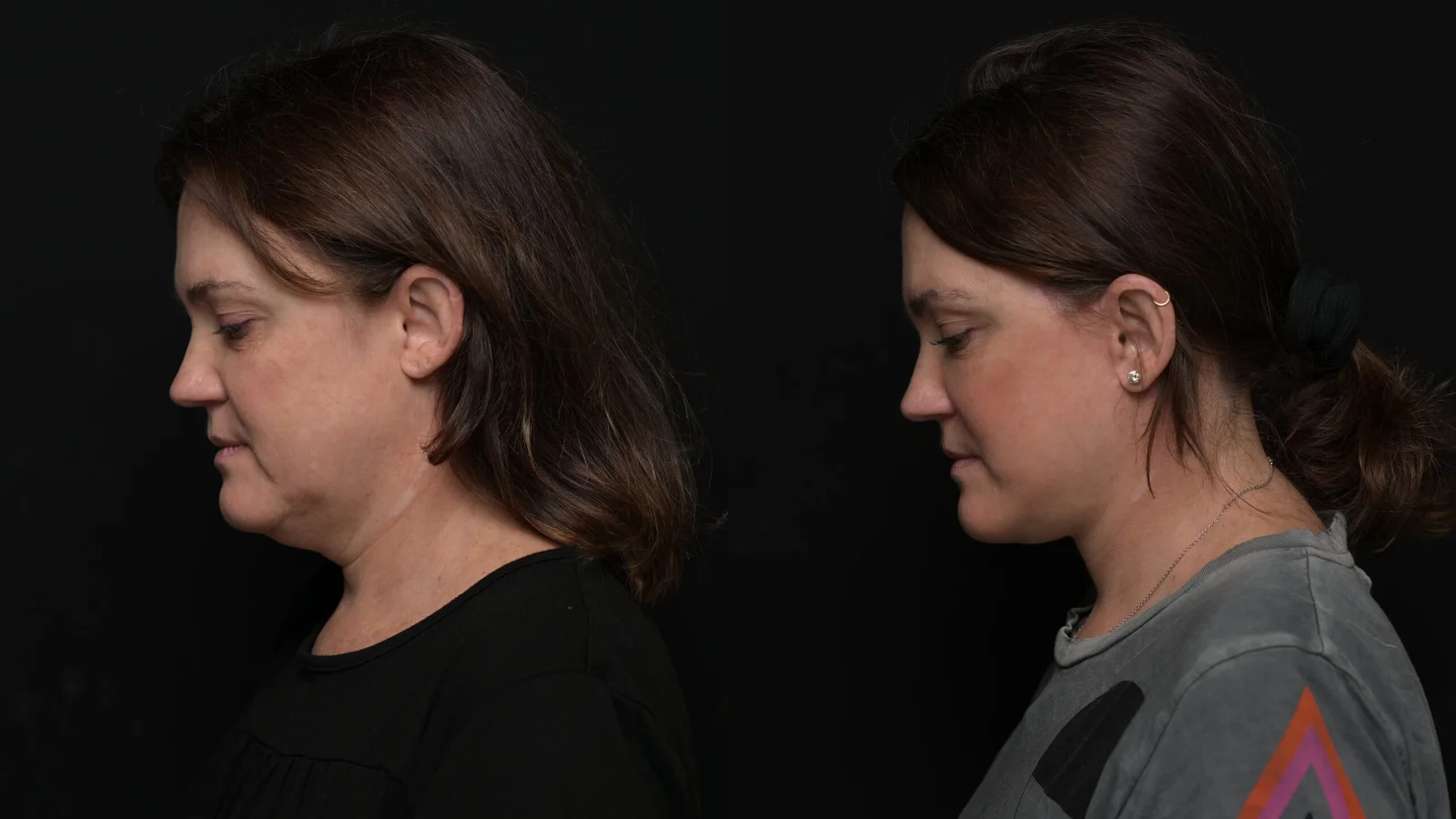 Before-and-after photograph, deep plane facelift and neck lift