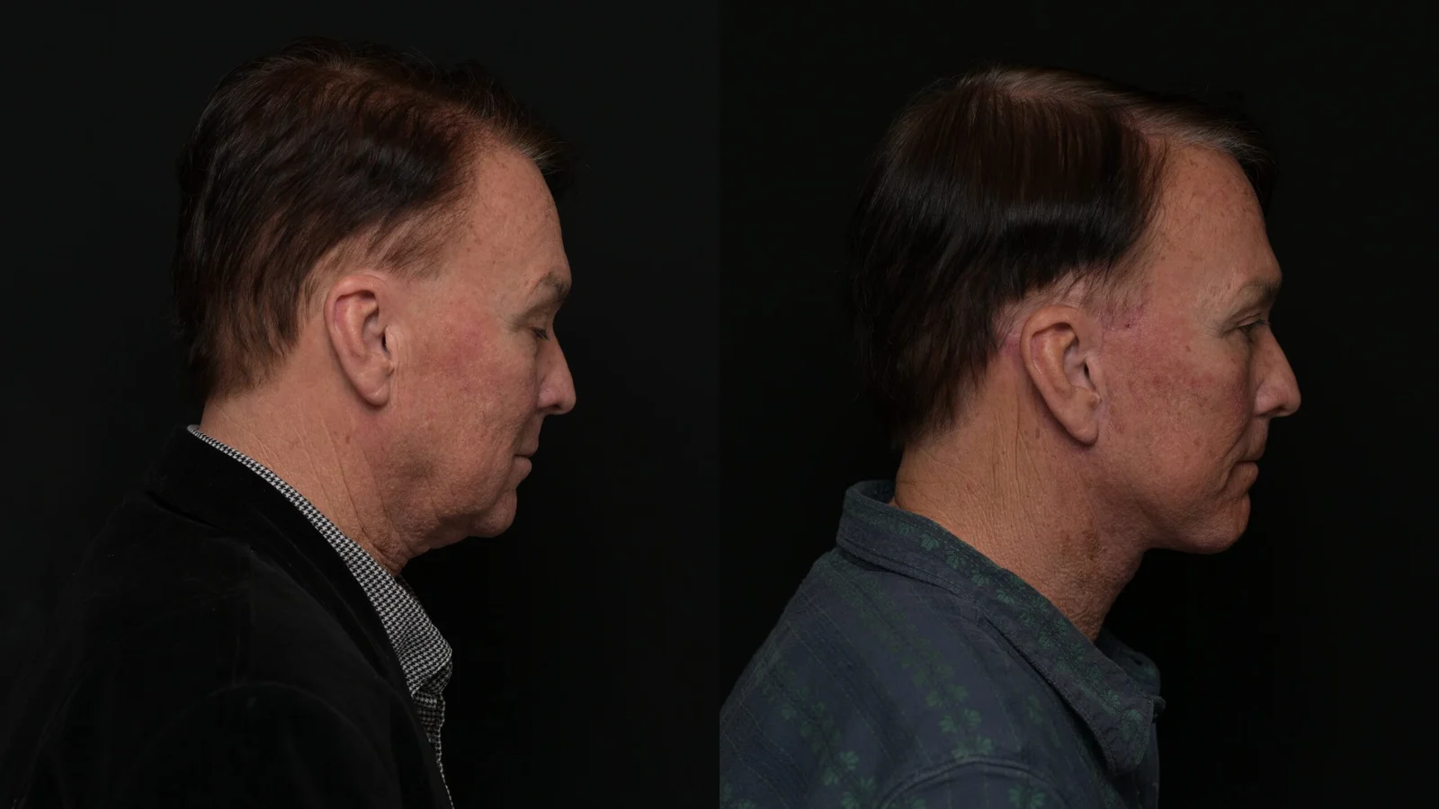 Before-and-after photograph, deep plane facelift and neck lift